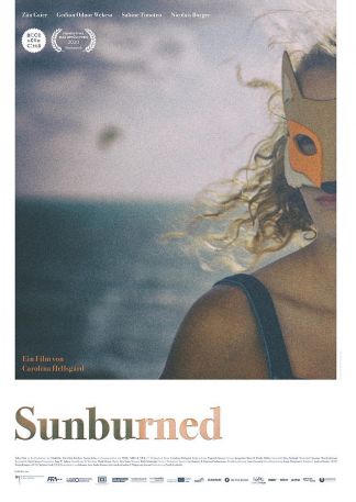 Sunburned
